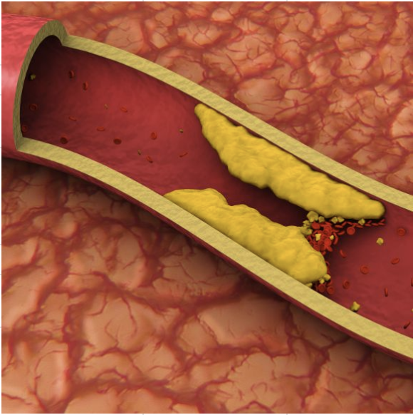 hypertension
